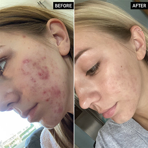 before and after using the inkey list products