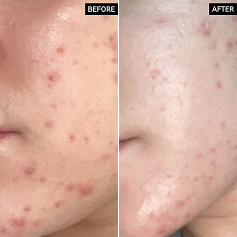 before and after acne spot treatment