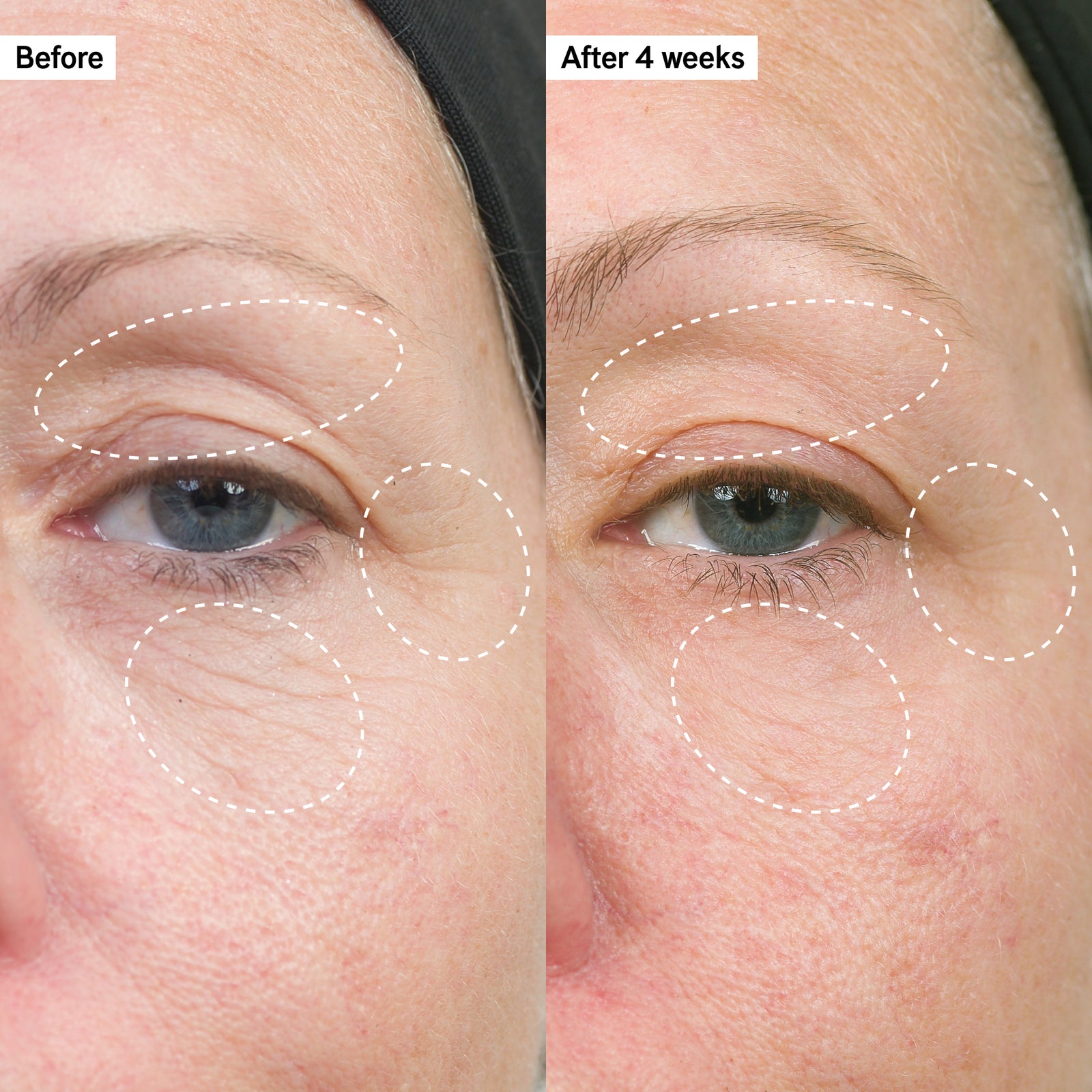 Before and after showing firmer skin around eyes