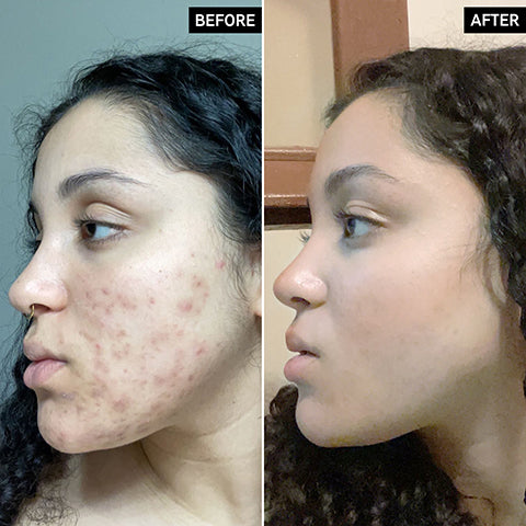 before and after acne scars