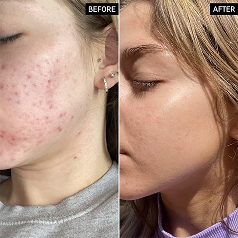 before and after using the inkey list products