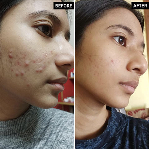 before and after acne treatment