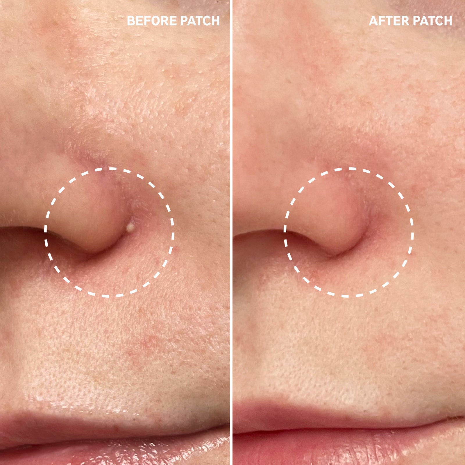 B&A using Pimple Patch showing reduced gunk