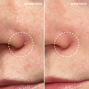 B&A using Pimple Patch showing reduced gunk