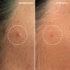 B&A using Pimple Patch showing reduced gunk