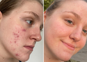 Real Results with INKEY: Cheek & Chin Acne